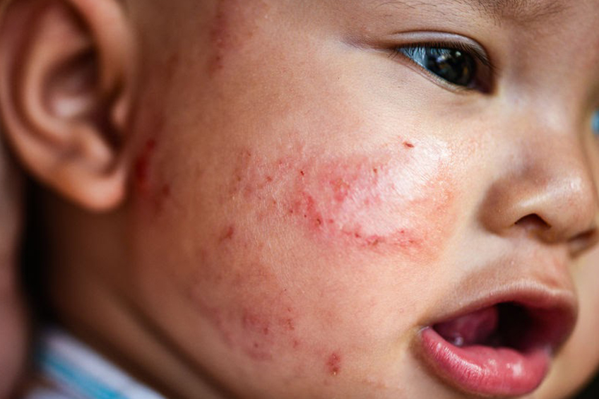 Types of baby rashes: Skin rash on toddler’s face
